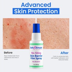 Safe n Simple No Sting Barrier Film Spray 2 oz Skin Protectant Ostomy Care