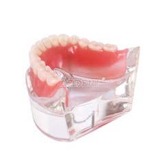 Modelo Demostración Implantes Dentales Sobredentadura Rehabilitada Sup/Inf 2 y 4