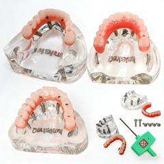 Dental Implant Model Upper Lower Jaw Demo All on 4/6 Overdenture treatment model