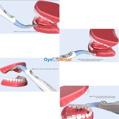Dental Implant Detector 3D Implant Locator System 270° Rotating Sensor Spotting