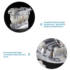 Dentalmall Dental Oral Typodont Model Implant Standard Size, Clear