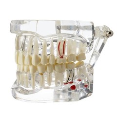 Dentalmall Dental Oral Typodont Model Implant Standard Size, Clear