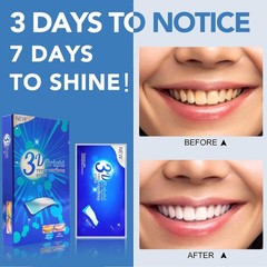 Dental Cleaning & Whitening Kit for Personal Use, 7 Count (Pack of 1)