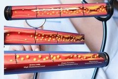 Edco Health Education Silent Destruction: How High Cholesterol Destroys Arteries