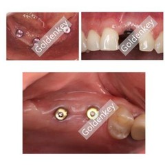Straumann RC Healing Abutment Closure Cap Titanium Fits ITI BLT Regular Screw