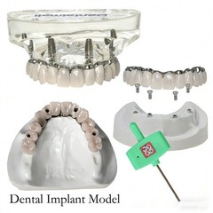 Dental Implant Model Upper Lower Jaw Demo All on 4/6 Overdenture treatment model