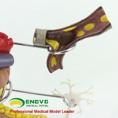 Medical Anatomical Human Diabetes Model 8 Parts Shows The Harm Of Diabetes
