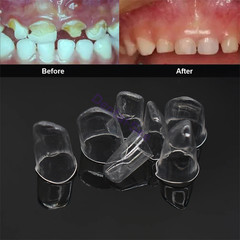 Dental Preformed Crown For Adults & Kids Temporary Pre-corona Anterior Molar