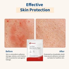 DERAYMI 100 Pcs Skin Barrier Wipes, Alcohol Free, No Sting Adhesive Wipes
