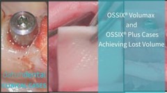 Dental OSSIX VOLUMAX Ossifying Collagen Scaffold by GLYMATRIX 15x25MM Free Ship