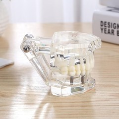 Dentalmall Dental Oral Typodont Model Implant Standard Size, Clear