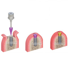 Dental Straumann Healing Abutments Closure Cover Screws NC/RC Fit ITI