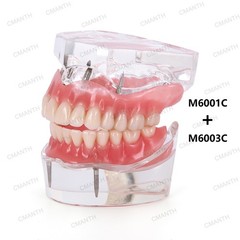 US Dental Implant Teeth Model Overdenture Restoration With4 Implants Upper Lower