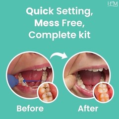 Zinc Oxide Eugenol Dental Cement Kit | Instant Tooth Repair & Crown Filling | DI