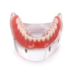 Modelo Demostración Implantes Dentales Sobredentadura Rehabilitada Sup/Inf 2 y 4