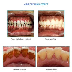 Dental LED Ultrasonic Scaler Scaling & Perio & Endo & Sand blasting & Implant