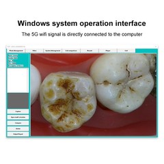 Dental Wireless Oral Viewer Intraoral Camera 1080p HD Intra Oral Camera