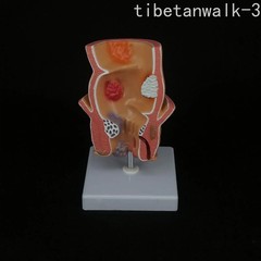 Anatomical Human Rectum Pathology Lesion Model Hemorrhoids Anus Rectal