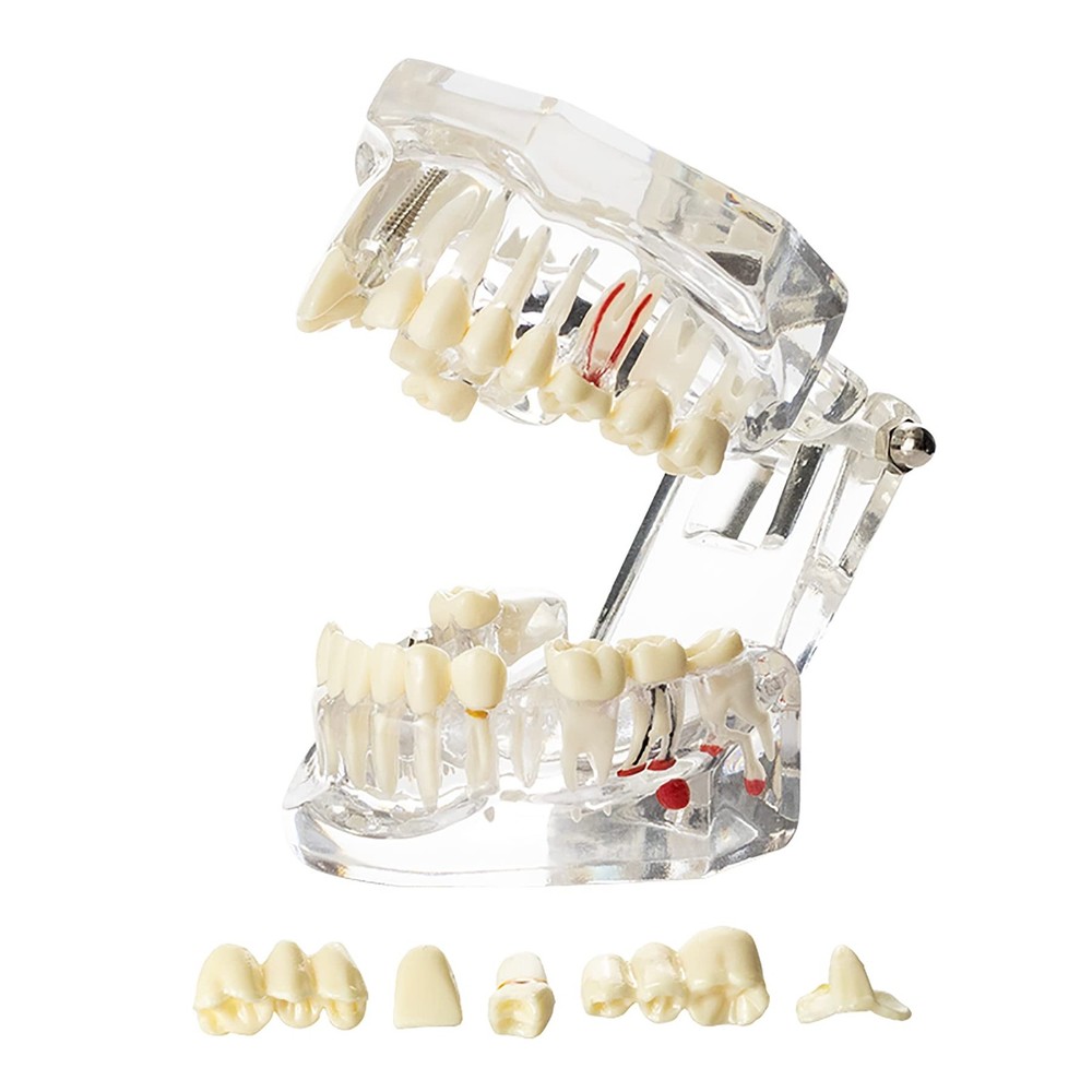 Dentalmall Dental Oral Typodont Model Implant Standard Size, Clear