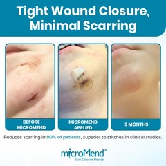 Micromend Emergency Wound Closure Kit Laceration To Butterfly 6 Sterile Wound