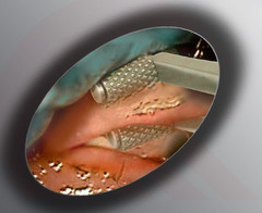 SS Meibomian Maskin Meibum Expressor Rollers Forceps Probing For Dry Eye s Gland