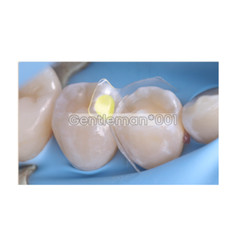 Dental Matrices Clear BT Posterior Molar Posterior Distal Contoured M4.5