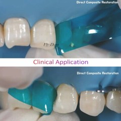 Dental M8 Contoured Anterior Matrix Restoration Matrices Polyester Blue Strip