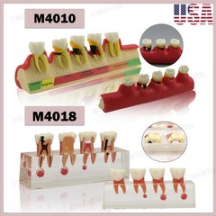 US Dental Model Upper Lower Jaw 4 Overdenture Practice Implant Typodont Demo