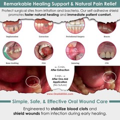 Ora-Aid 4 single-use packs | Self-Adhesive Intraoral Wound Dressing