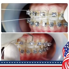 Dental Ligature Ties Orthodontic Wire Preformed Long Short Stainless Steel 100pc
