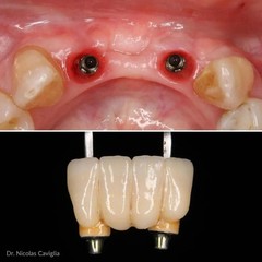 CEREC® Blocks Lithium Disilicate x5