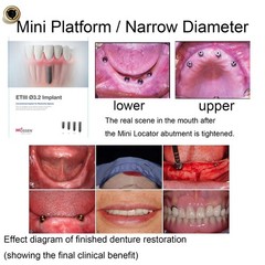 US Dental Locator Abutment For BioHorizons/Hiossen/Nobel/Zimmer Multiple Implant