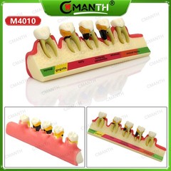 Dental Pathological Typodont Teeth Model Periodontics/Implant/Endodontic Caries