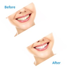 10-1Pc Dental Gingival Gel Dam Barrier Gum Protector Syringe Teeth Whitening 3ml