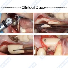 Dental Semilunar Bone Collector Drill GBR SLT Semilunar Techniqu Argumentation