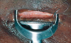 3Pc Waddell Clamp 18mm,22mm,26mm Bilamellar Tarsal Trachomatous Trichiasis Insts