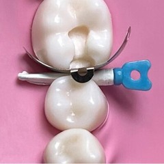Dental Tulwar Wedges Sectional Matrix System Plastic Diastema Wedge Refill S/M/L