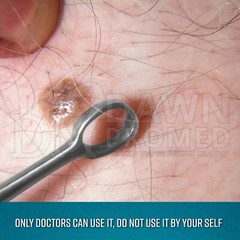 Fox Dermal Curettes Dermatology 1mm – 6mm ENT Instruments German Grade