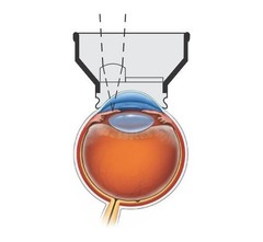 Top Quality YAG Iridectomy Lens For ND YAG Laser Surgery Procedure & Free Ship