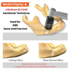 Dental Bone Collector Drill SLT Semilunar Technique Bone Harvest GBR Drill USA