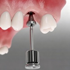 US Dental Healing Abutment Cap Mini Regular Platform Fits Ostem Hiossen Implant