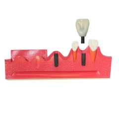 Dental Implant Model Upper Lower Jaw Demo All on 4/6 Overdenture treatment model