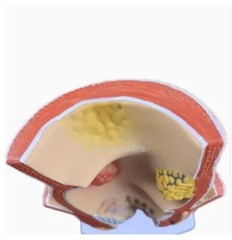Anatomical Human Rectum Pathology Lesion Model Hemorrhoids Anus Teaching Supply