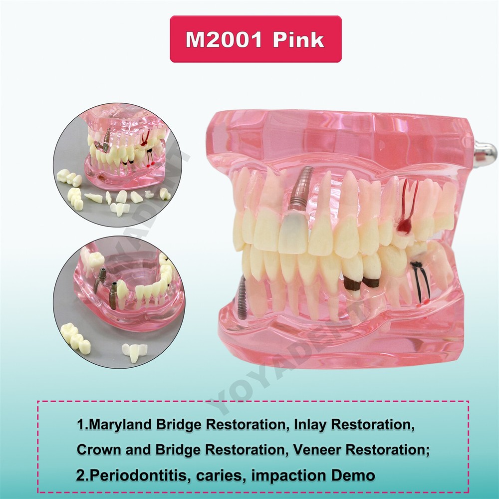 Multiple Types Dental Teeth Model Ortho Implant Practice Teaching Demo Model