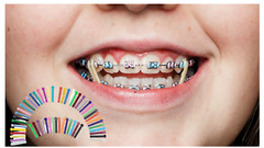 Dental Orthodontic Braces Ligature Ties Elastic Rubber Bands Mixed Color ARTMAN
