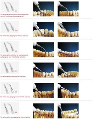 20X Ultrasonic Piezo Scaler Insert Scaling Perio Tips for Satelec DTE Handpiece