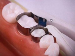 Dental Pro Matrix Bands Adjust Matriz Matrices System Clamp Dentistry Tool Clip