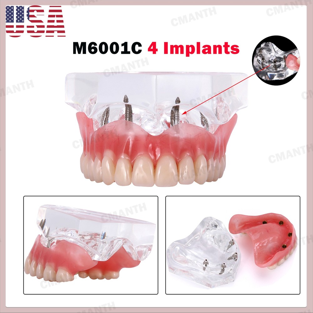 US Dental Model Upper Lower Jaw 4 Overdenture Practice Implant Typodont Demo