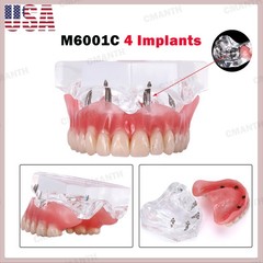 US Dental Model Upper Lower Jaw 4 Overdenture Practice Implant Typodont Demo