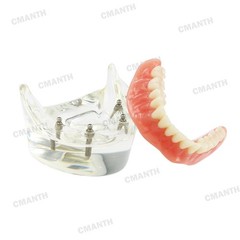 US Dental Model Removable Overdenture Teeth Upper/Lower Jaw 4 Implants Model